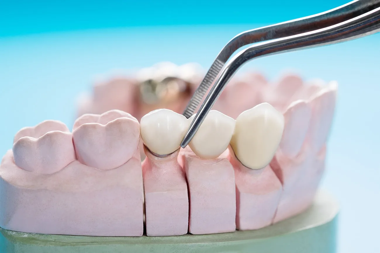 Capsula in Ceramica