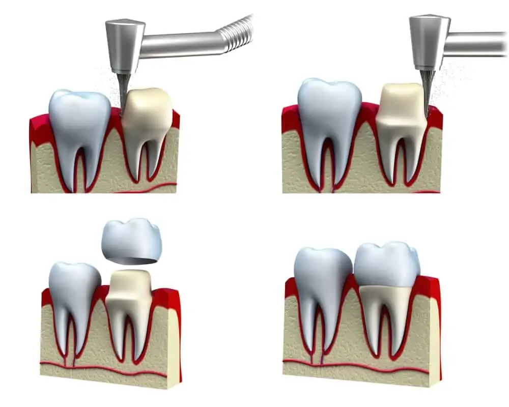 Capsula in Ceramica2