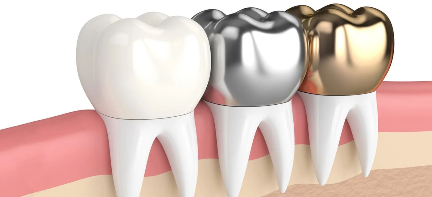 Capsula in Ceramica3