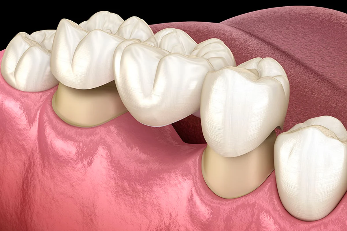 Corona in Ceramica su Zirconioi2