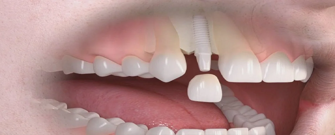 Denti Al Zirconio4