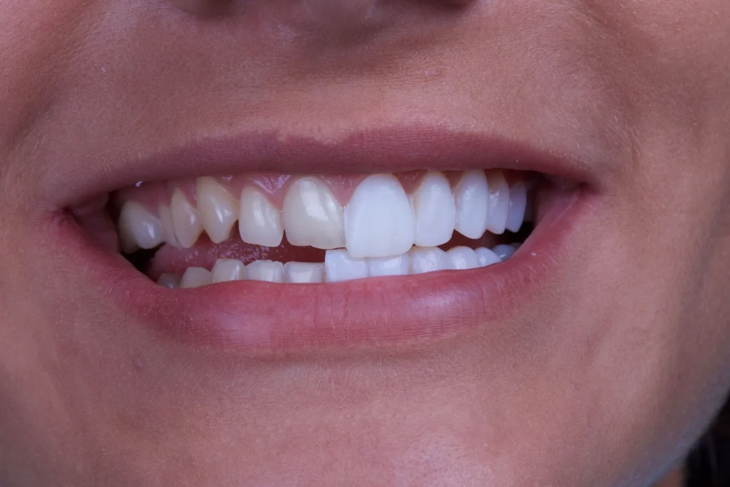 Denti Estetici2