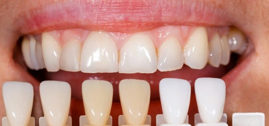Denti Estetici3