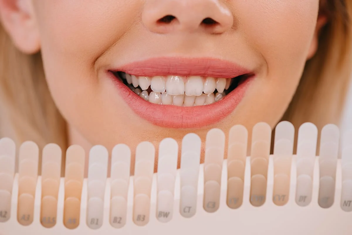 Denti Estetici4