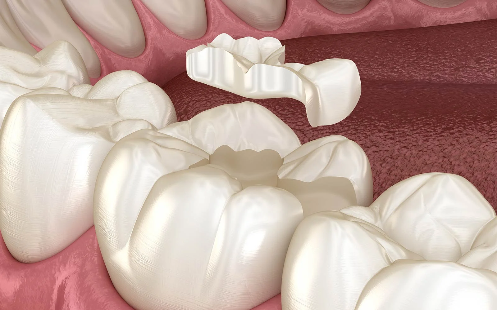 Denti in composito o ceramica1