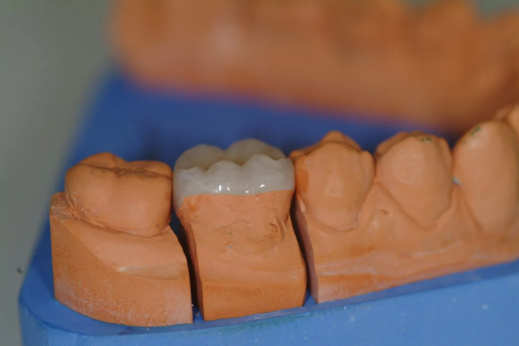Denti in composito o ceramica3