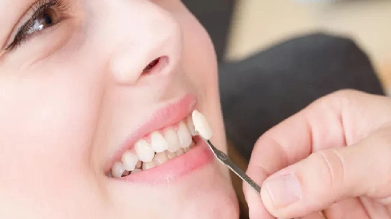 Denti in composito o ceramica5