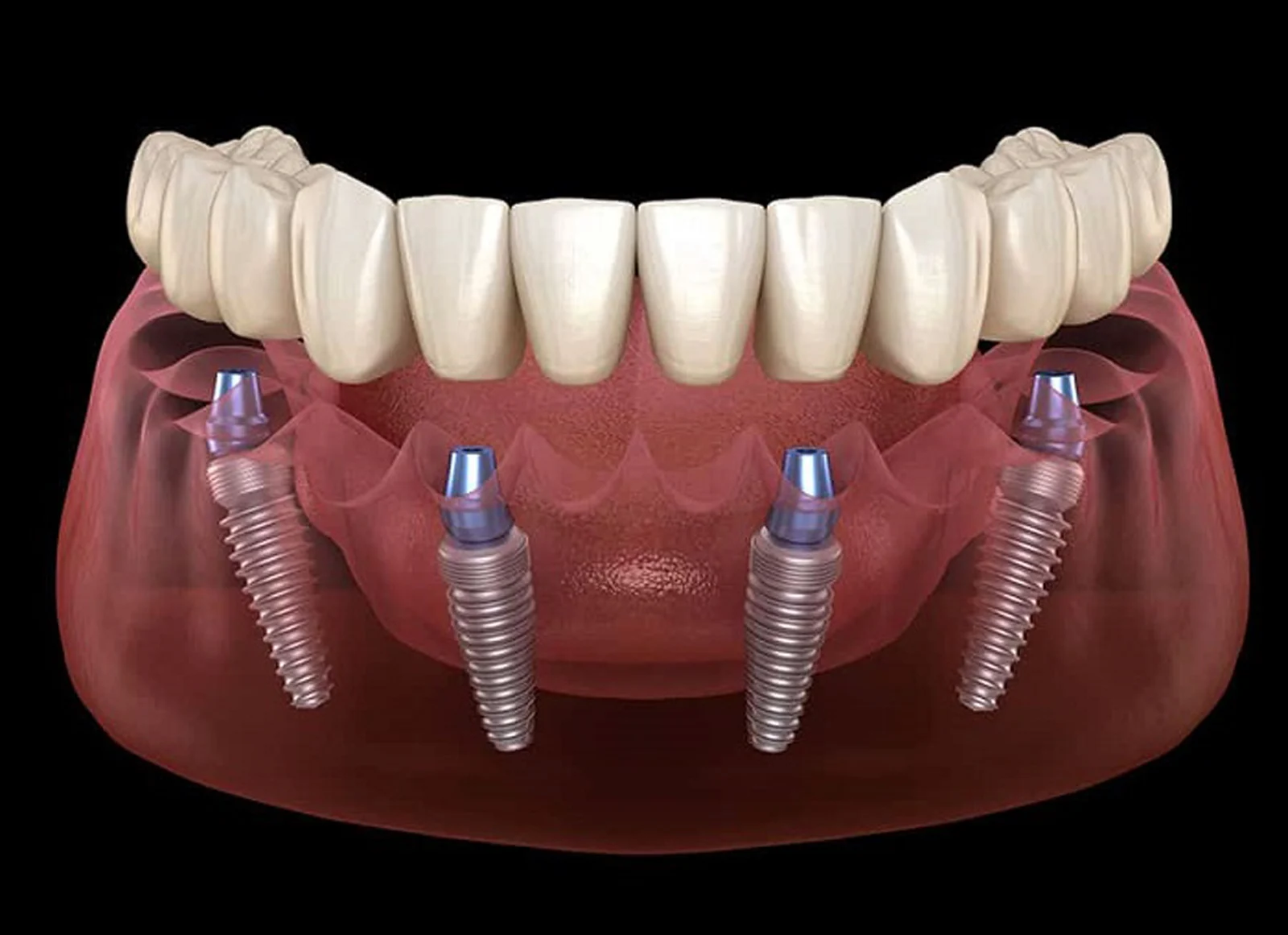 Impianti Dentali1 Impianti Dentali: Tutto Quello Che Devi Sapere