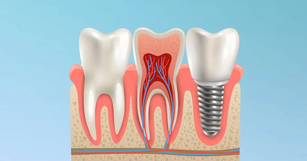Impianti Dentali2 Impianti Dentali: Tutto Quello Che Devi Sapere