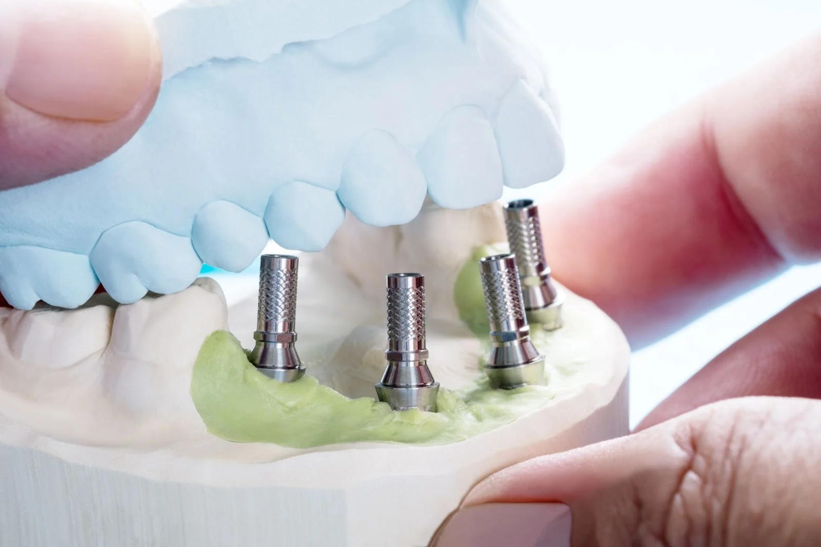 Impianti Dentali3 Impianti Dentali: Tutto Quello Che Devi Sapere