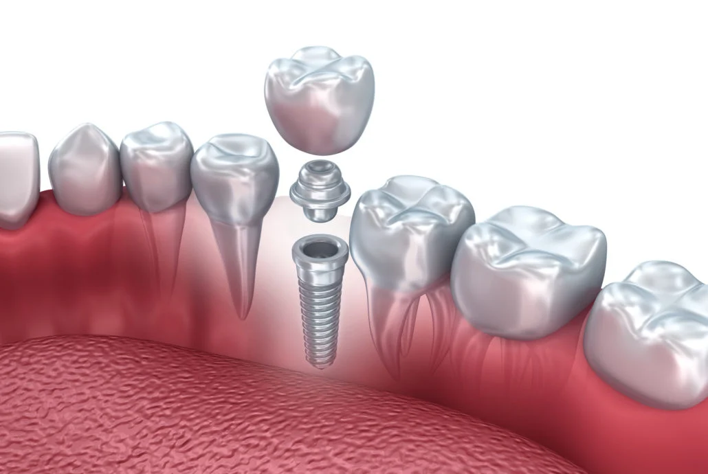 Impianti Dentali4 Impianti Dentali: Tutto Quello Che Devi Sapere
