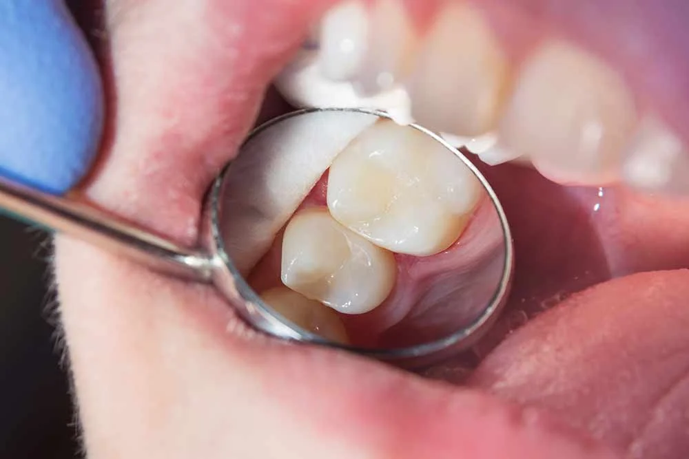 Ricostruzione Dente in Composito Durata2