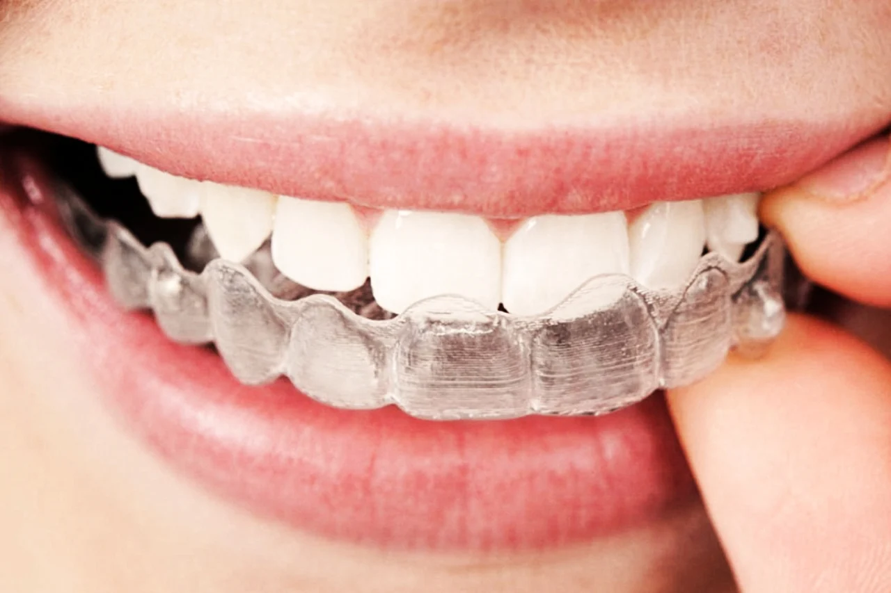 Sbiancamento Dentale Con Mascherine