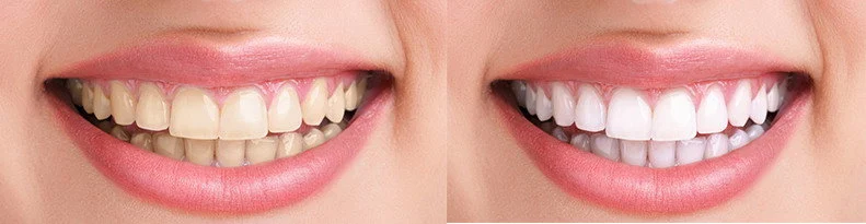 Sbiancamento Dentale Con Mascherine3