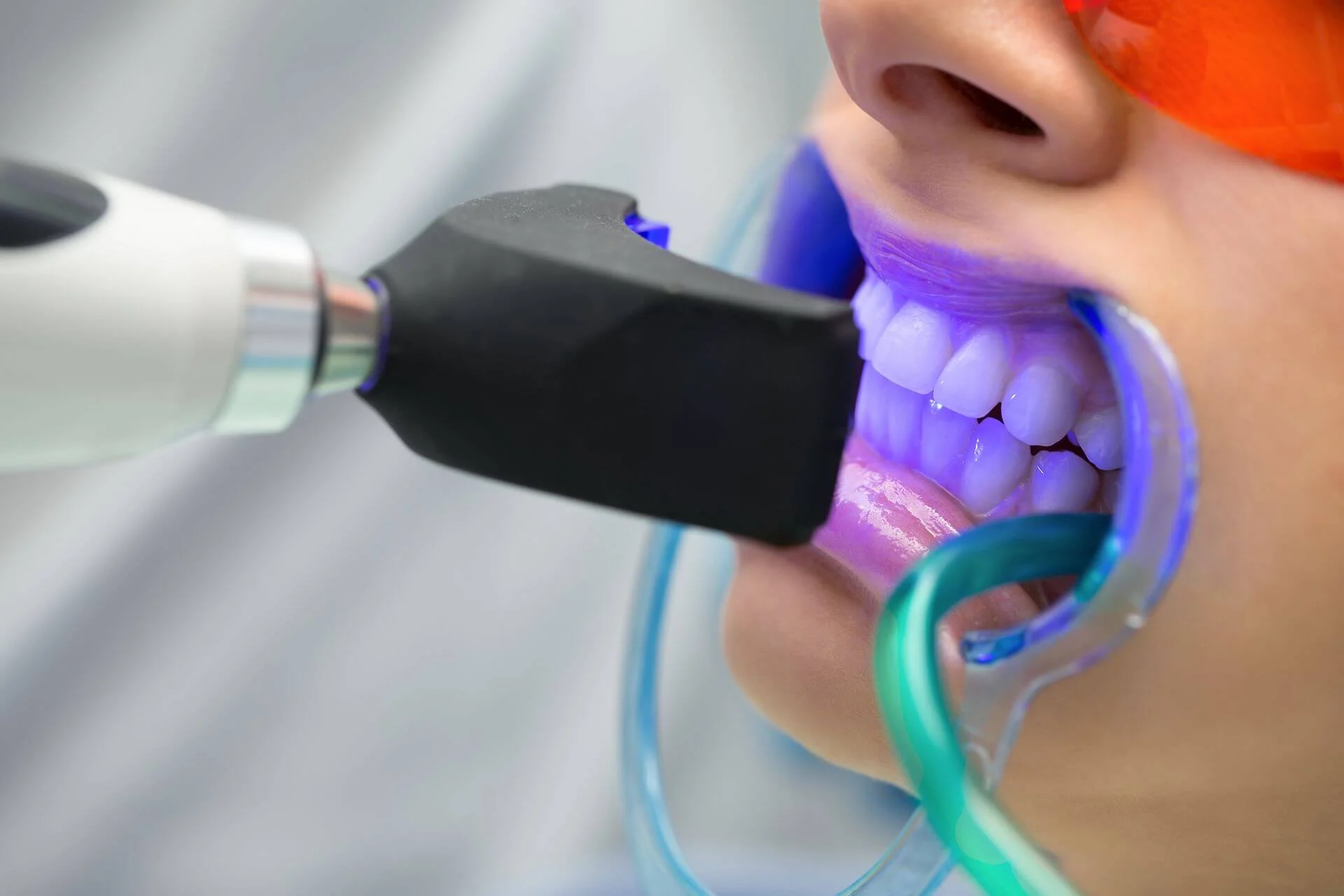 Sbiancante Denti1 Sbiancante Denti: Tutto Quello Che Devi Sapere Per Un Sorriso Perfetto