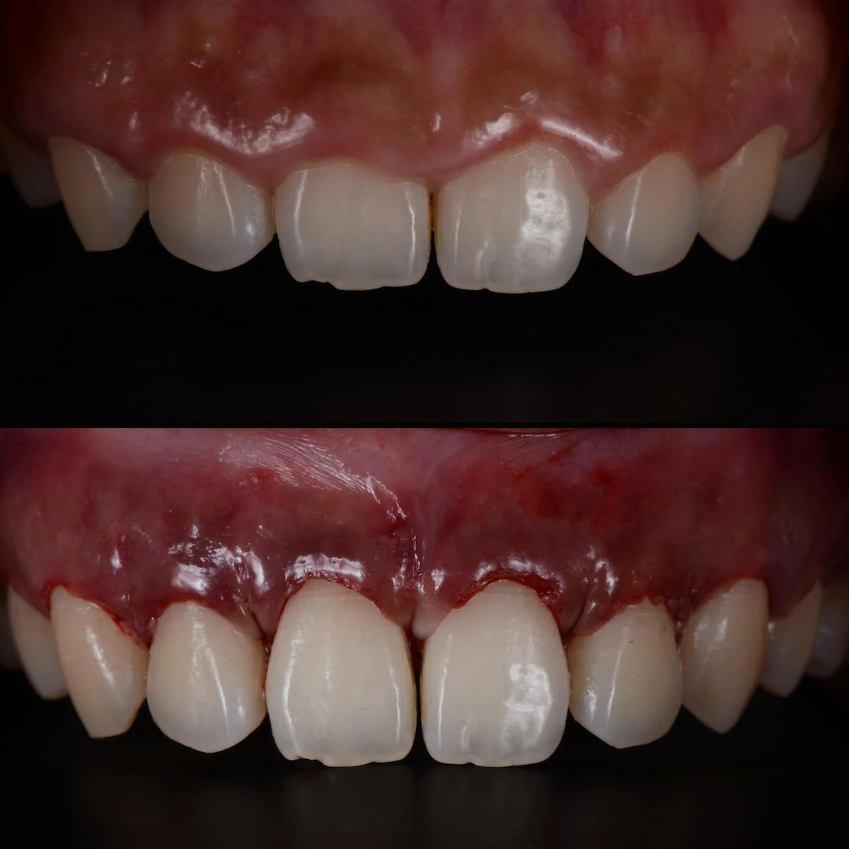 Gum Lift1 1