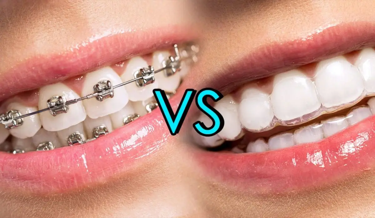 INVISALIGN1