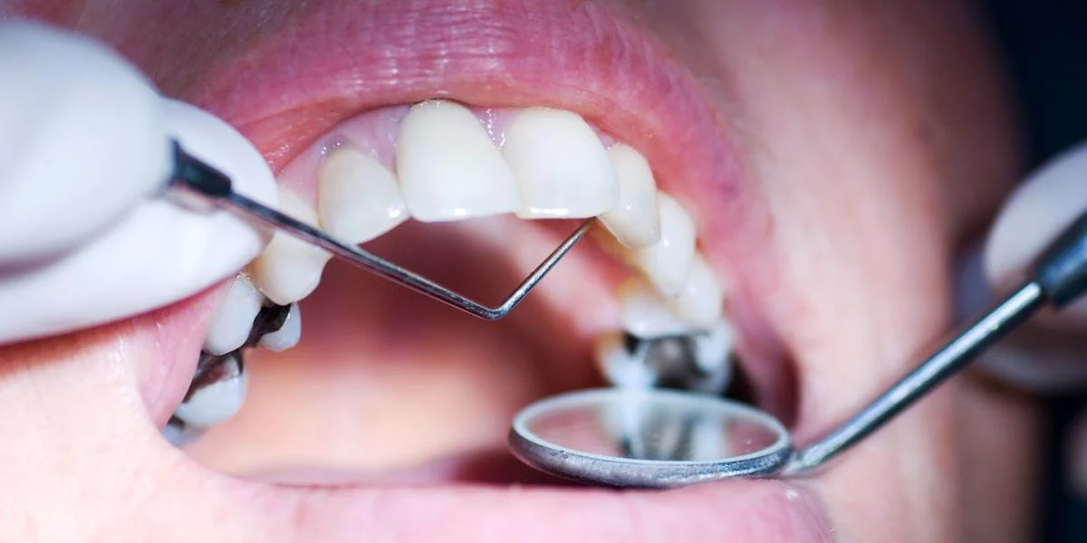 Losers Cavity1