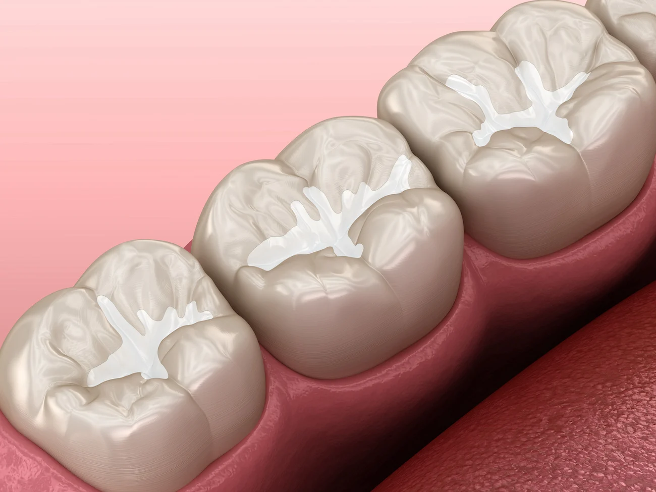 Sealants1 1