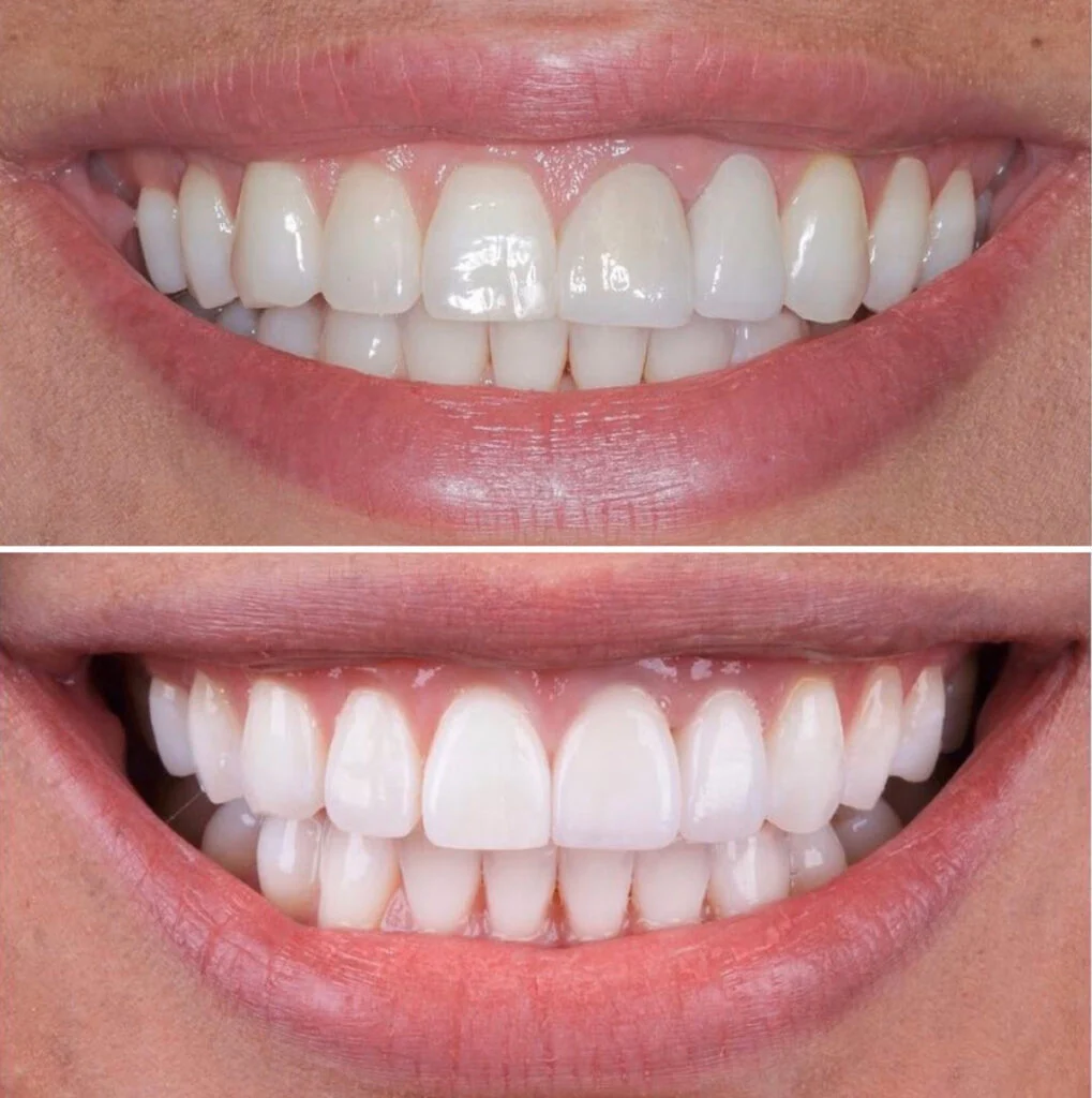 Veneers E MAX3