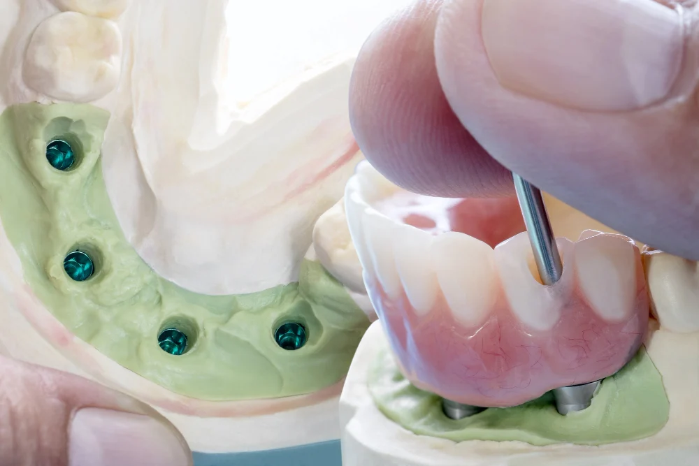 protesi per denti5 Dentiere Mobili di Ultima Generazione: Innovazioni, Tipologie e Prezzi