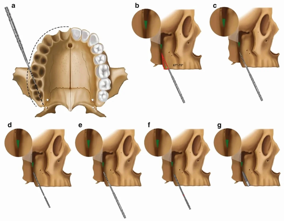 pterygoid dental implants2