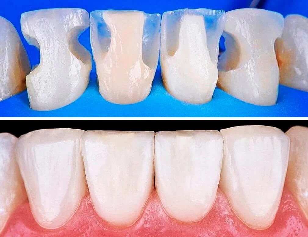 Bonding Dentale.2