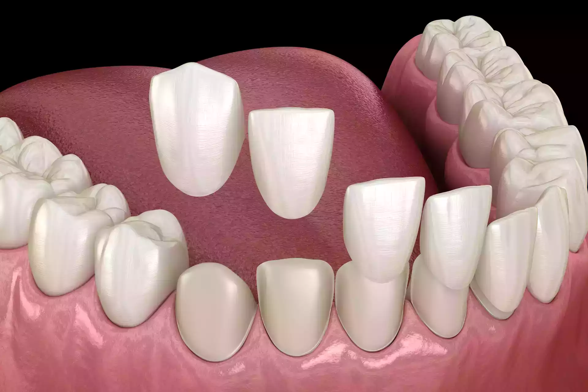 Bonding Dentale.3