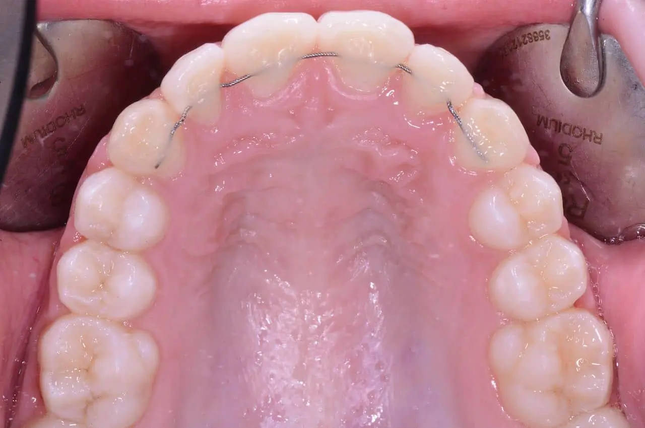 Contenzione denti1