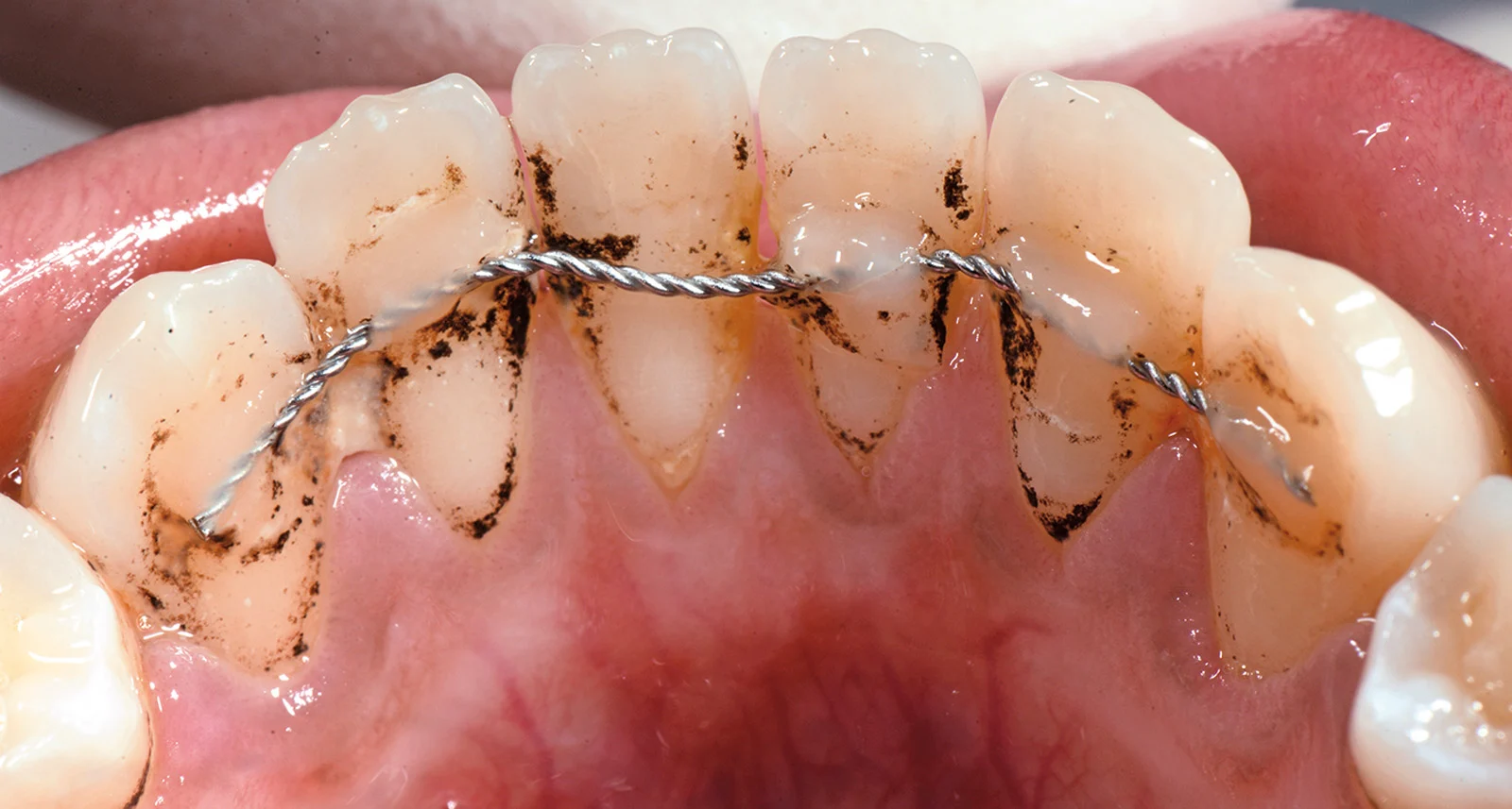 Contenzione denti2