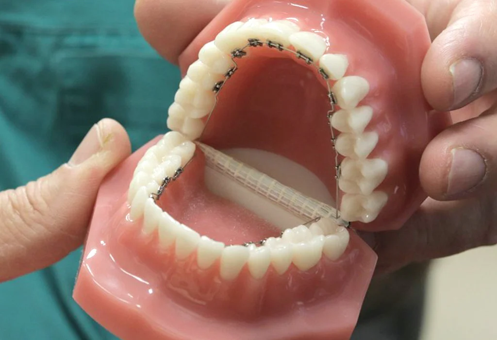 Contenzione denti3