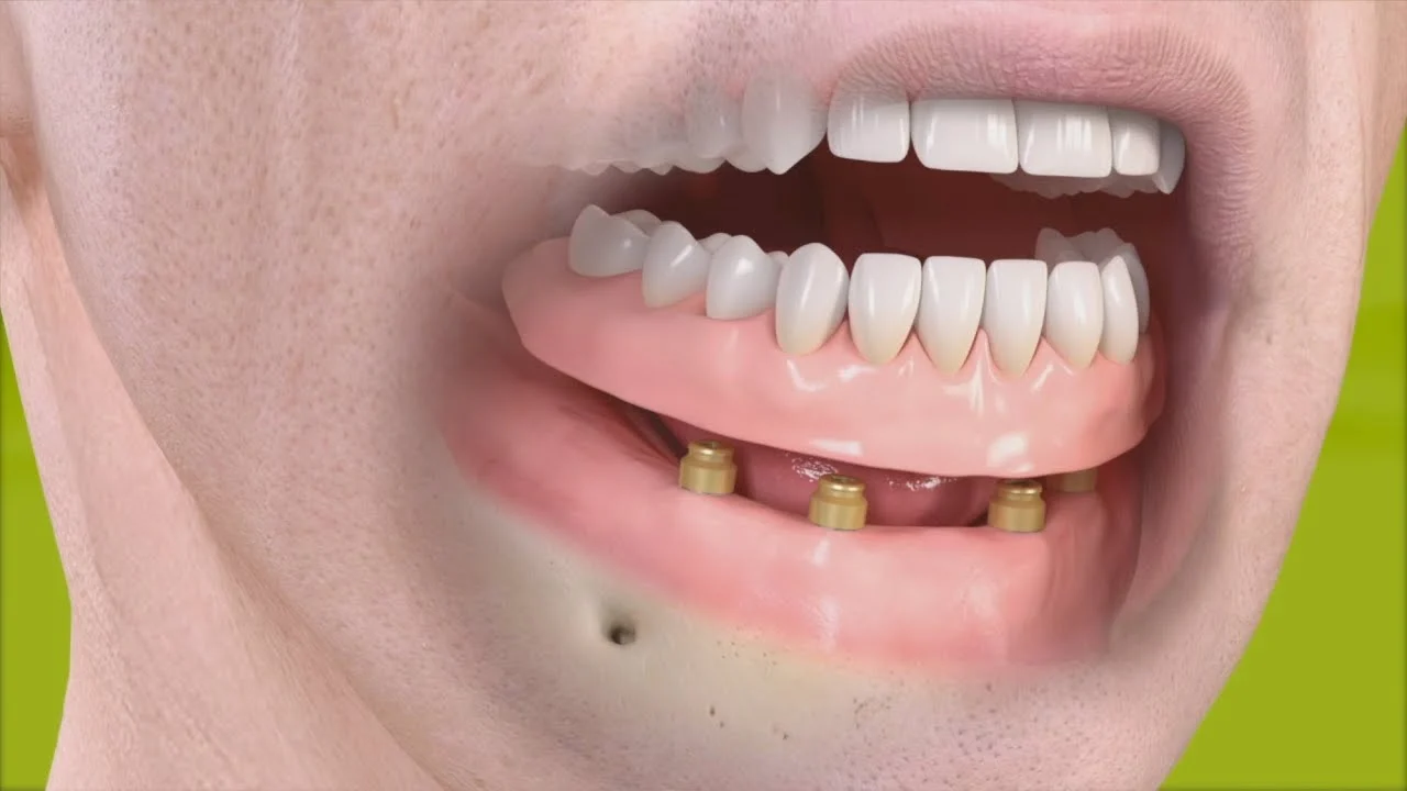Dentiere3