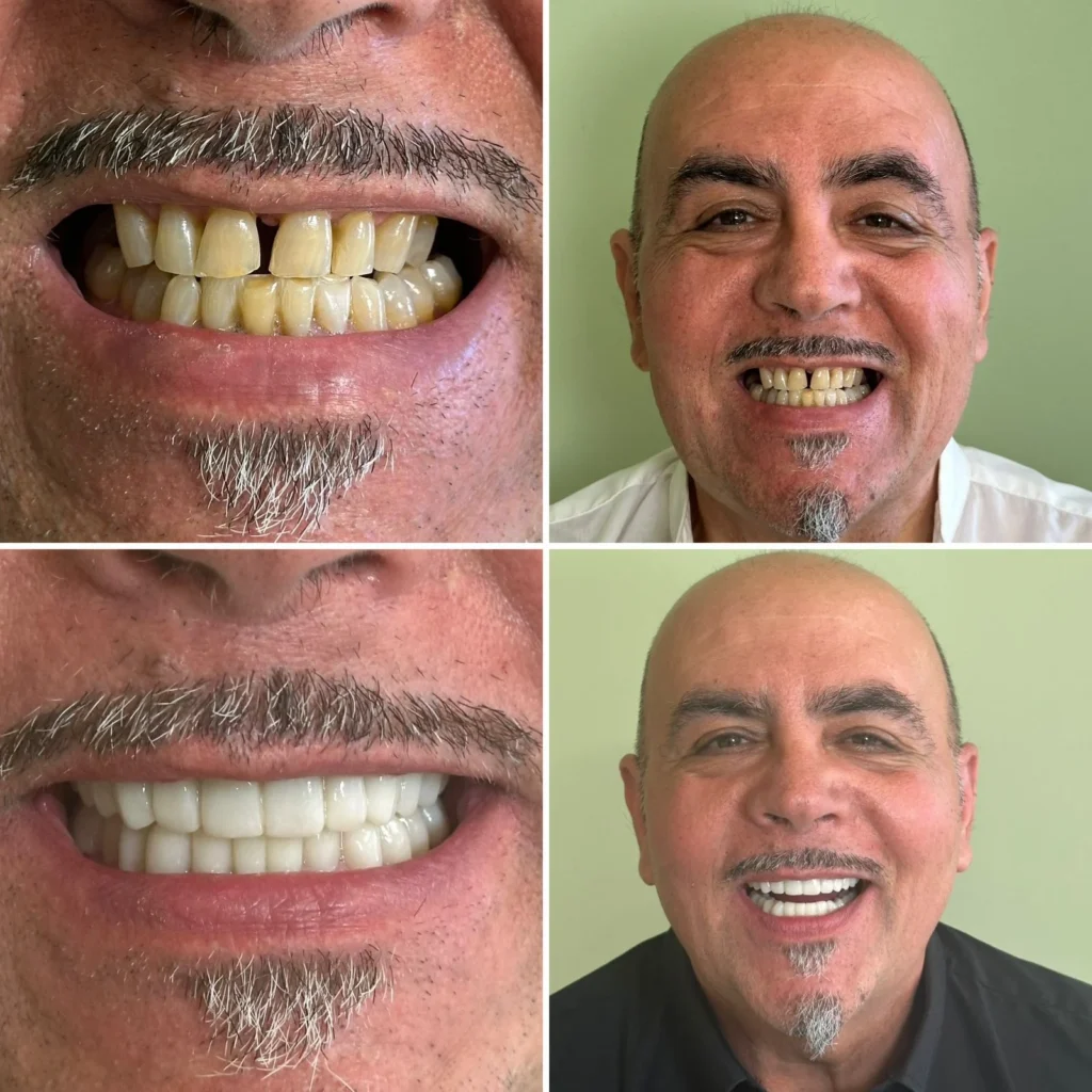 Full mouth dental implants before and after at Dentale Albania clinic in Tirana