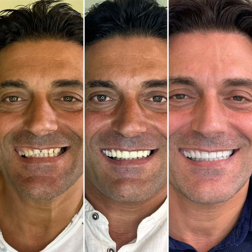 Full mouth dental implants before and after at Dentale Tourism clinic in Tirana