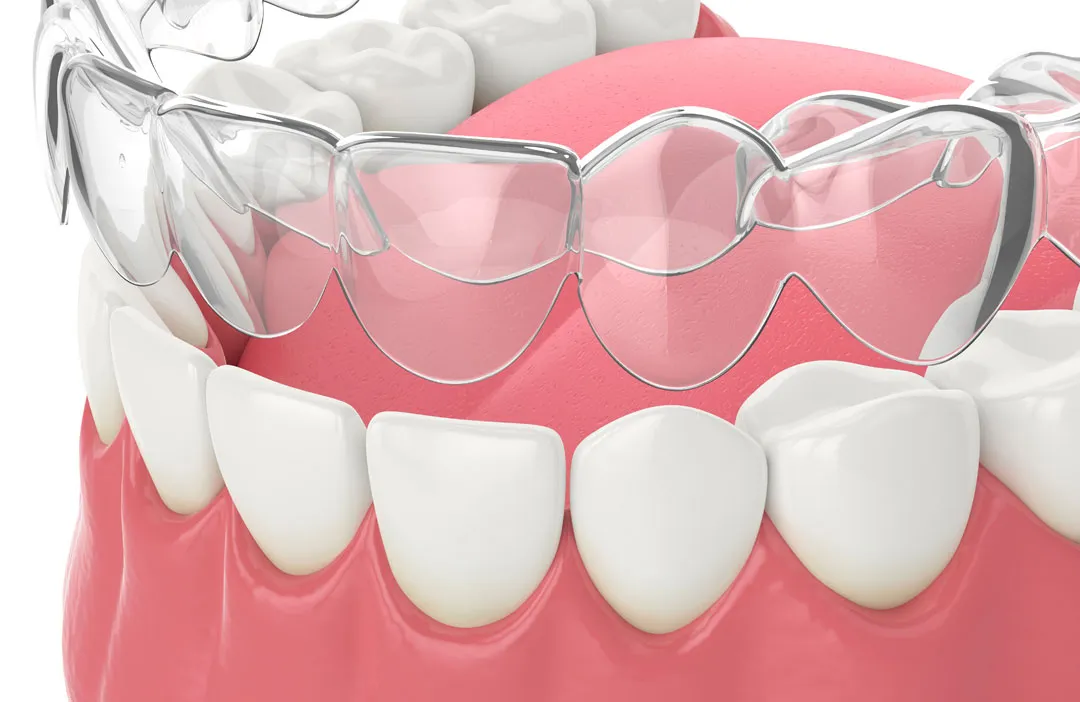 INVISALIGN.3