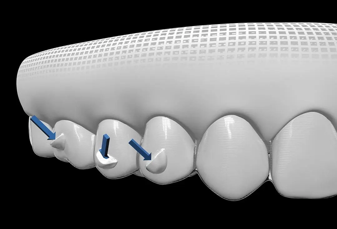 INVISALIGN