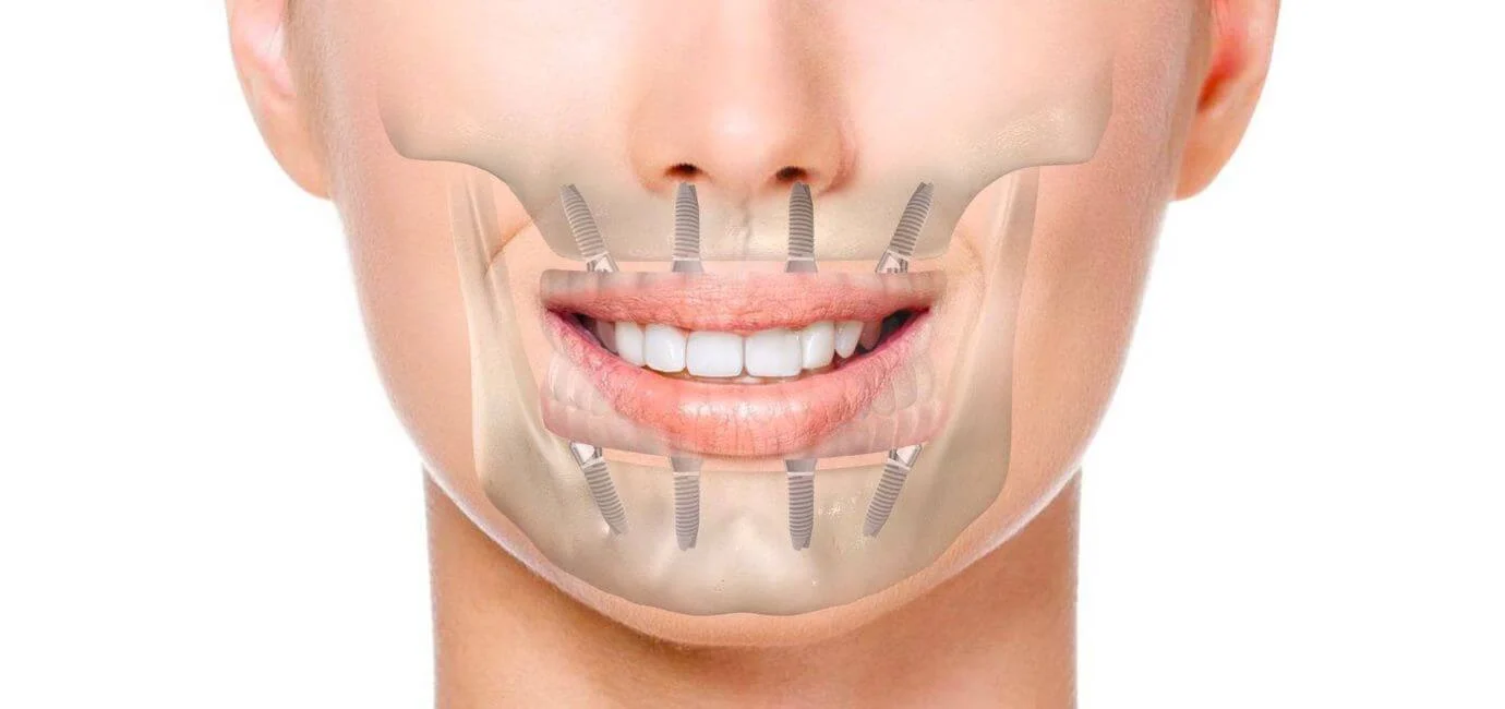 Impianto dentale a carico immediato2