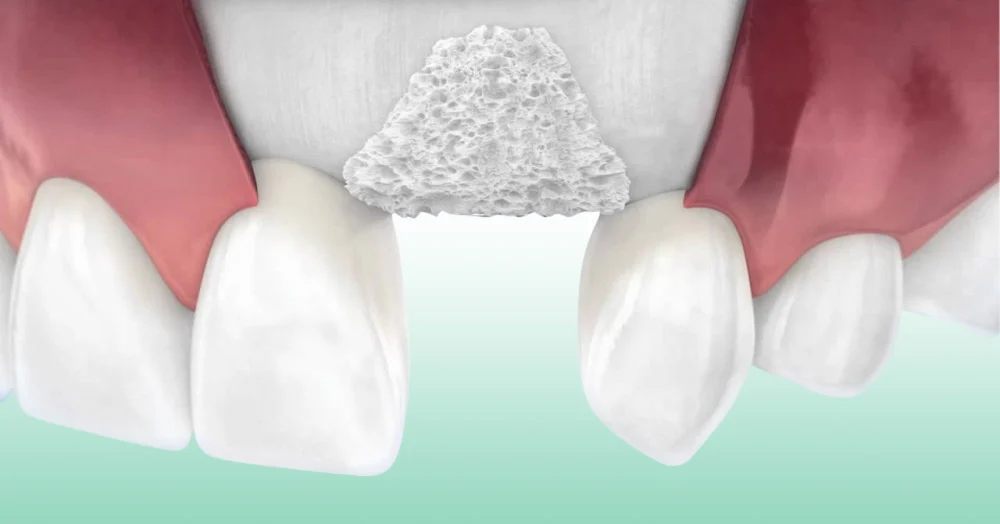 Innesto osseo per impianto dentale1