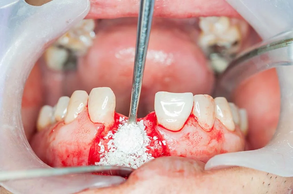 Innesto osseo per impianto dentale2