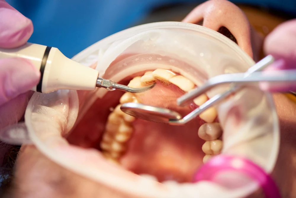 Innesto osseo per impianto dentale3