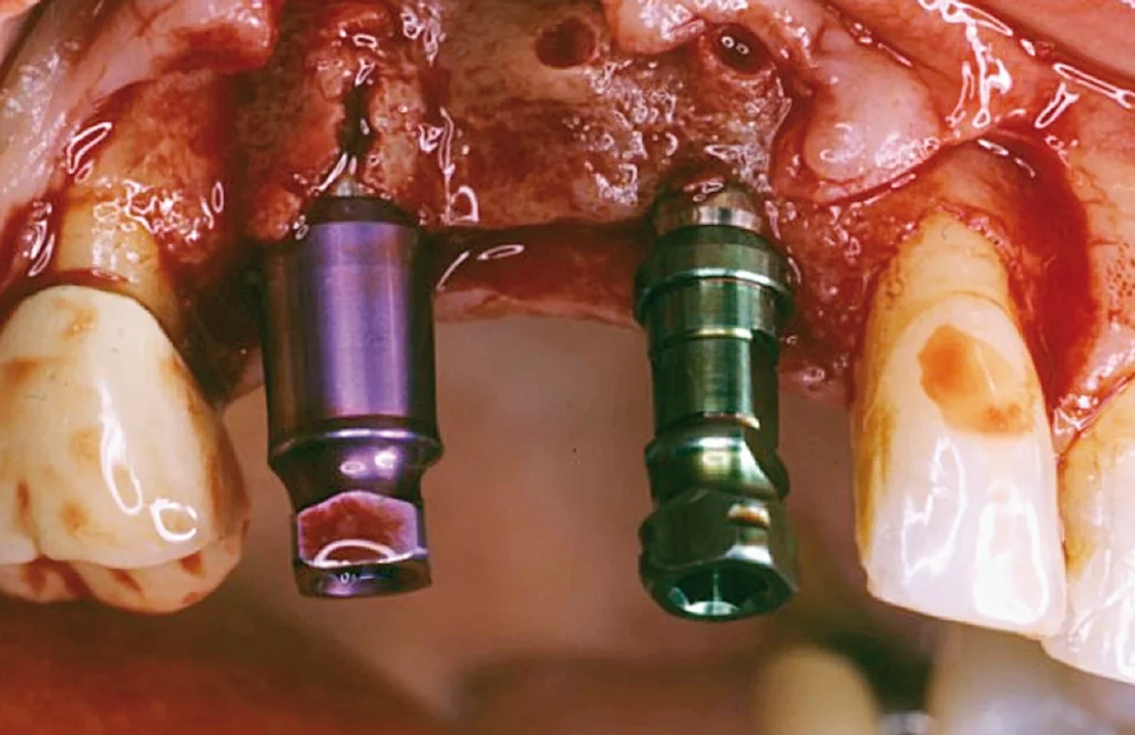 Innesto osseo per impianto dentale4