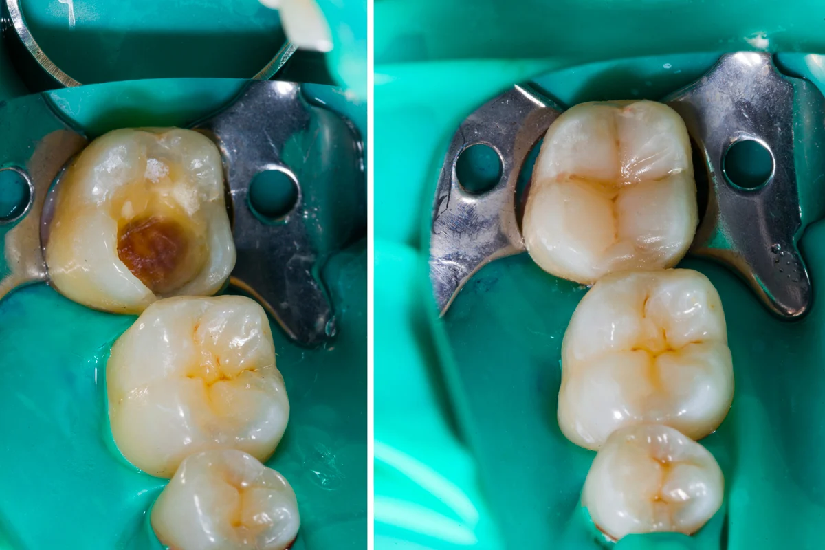 Otturazione dente