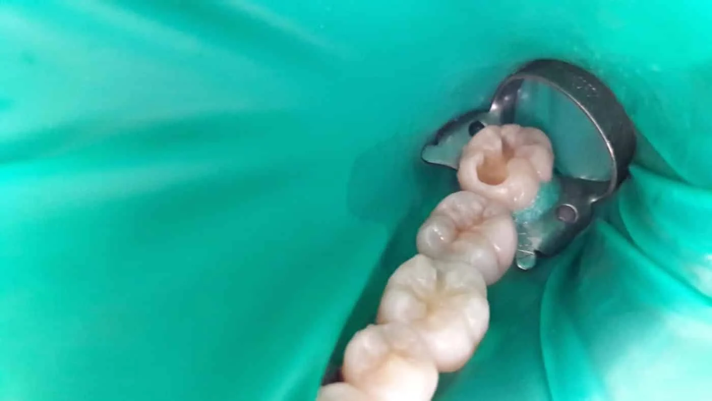 Otturazione dente3