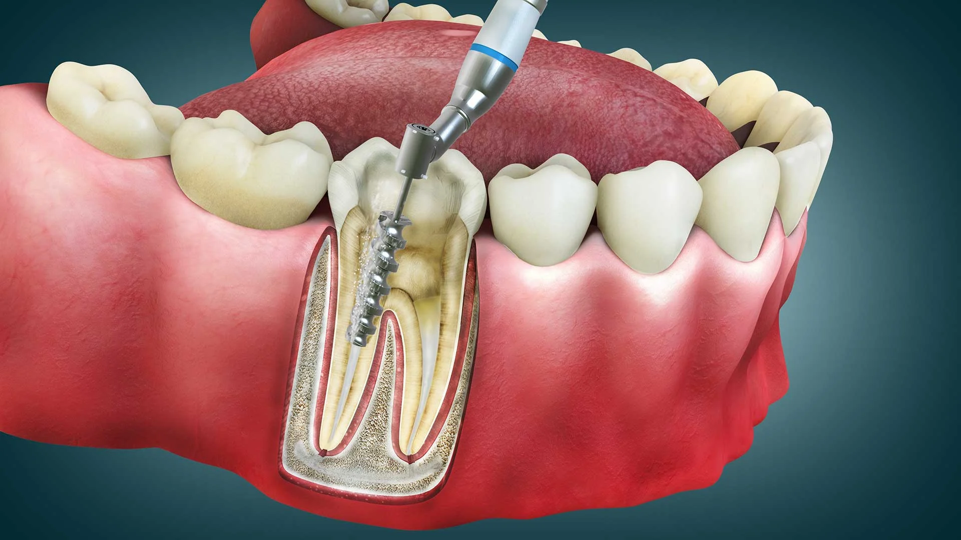 Root canal therapy1