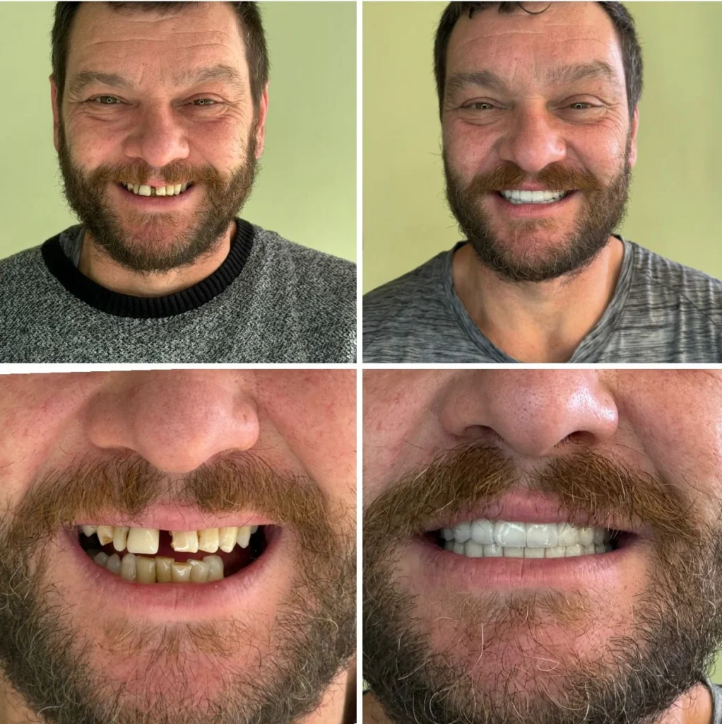 Full mouth dental implants before and after at Dentale Tourism Albania clinic in Tirana