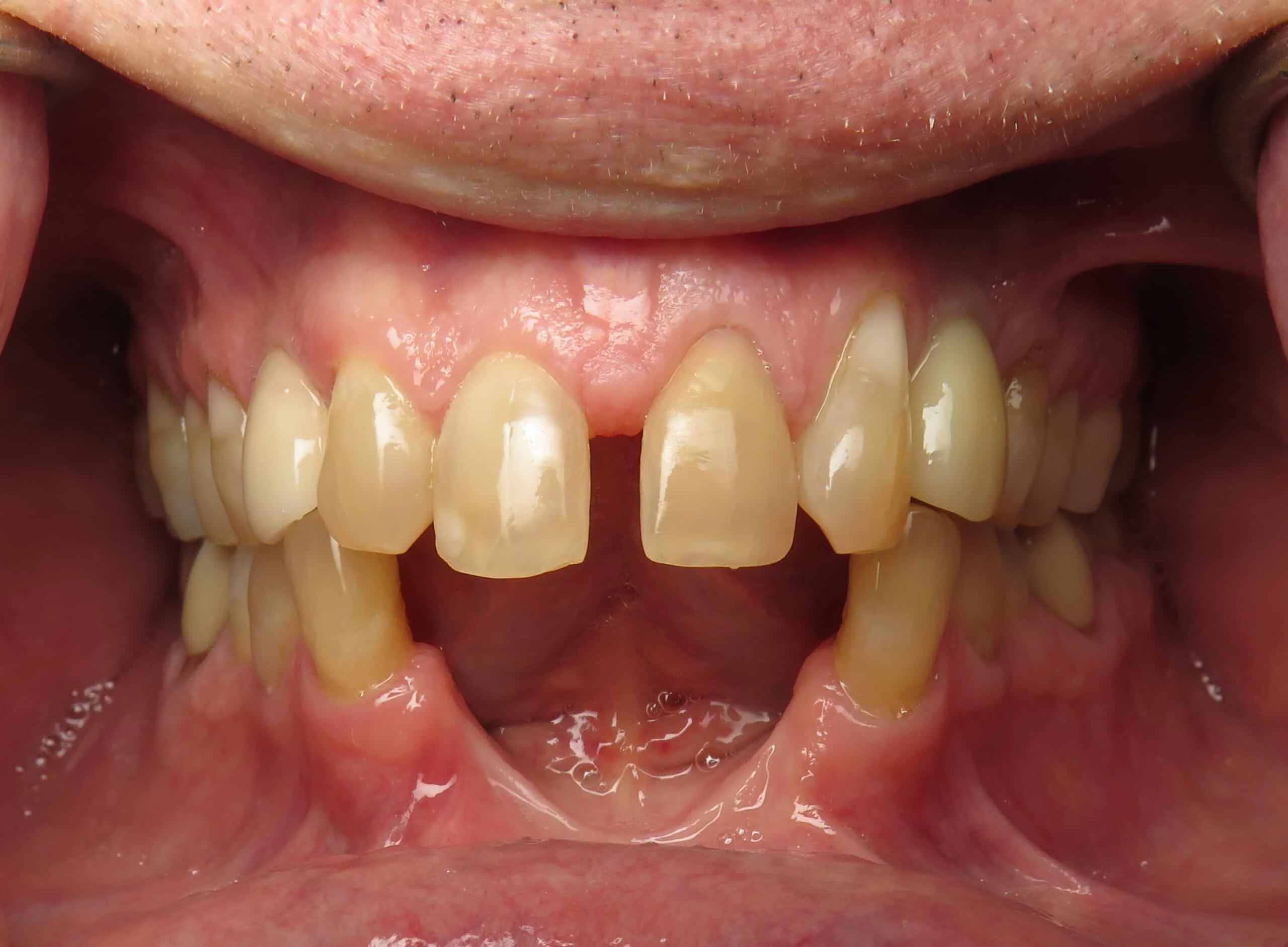 dental bone graft1