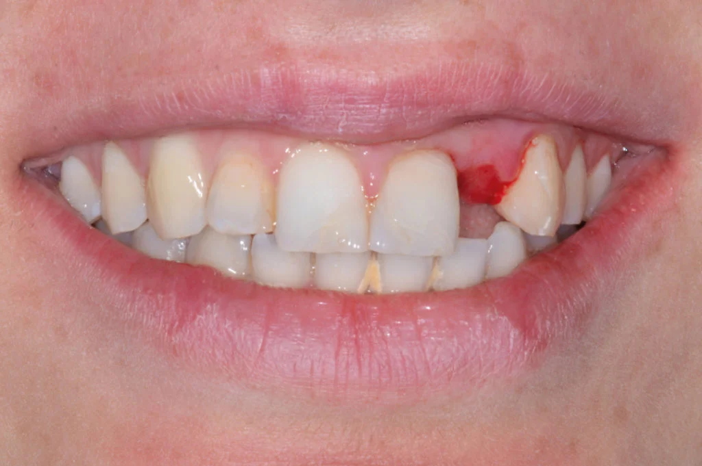 dental bone graft2