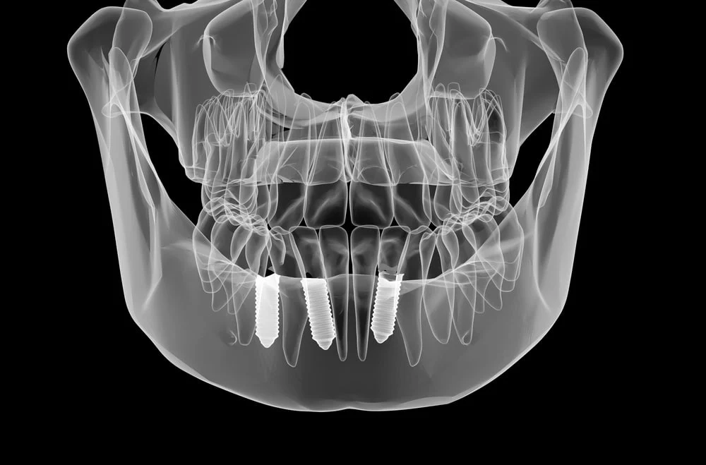 dental bone graft3