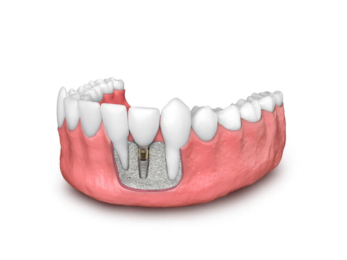 dental bone graft4