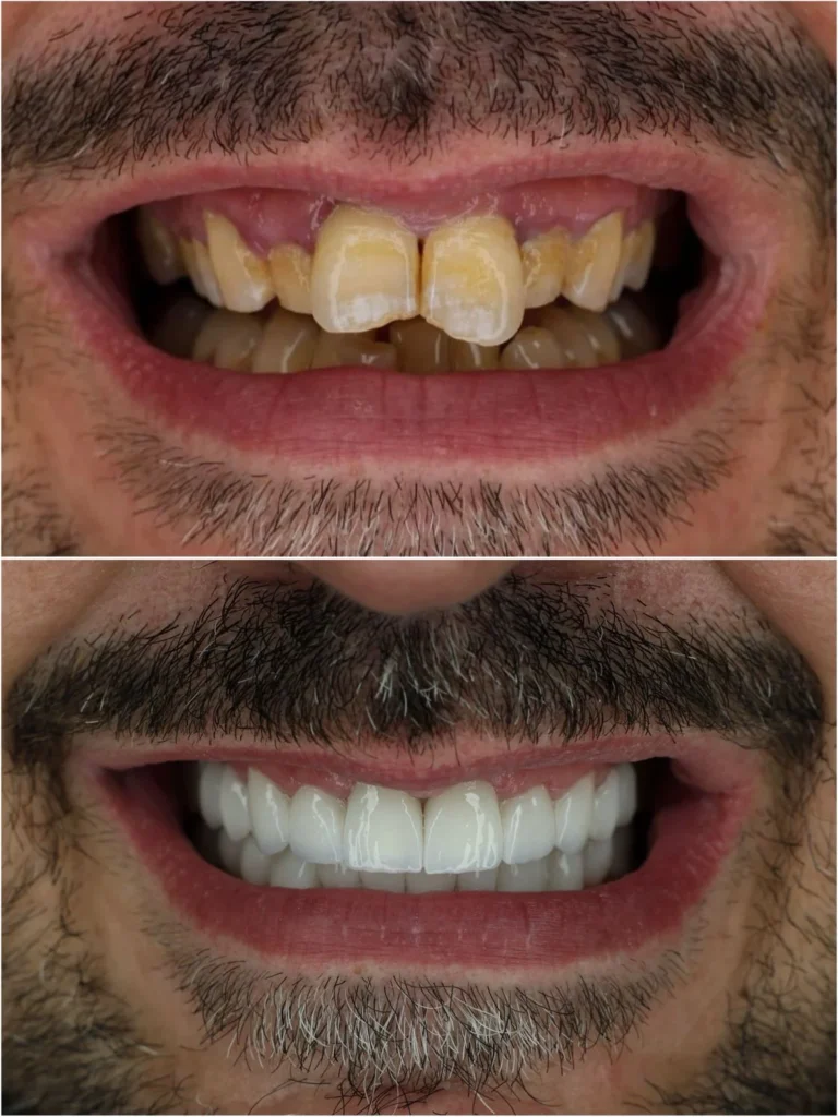 dentale albania Dental Tourism Albania